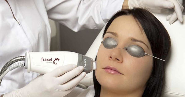 Leading Santa Monica Dermatologist Introduces the New FRAXEL Laser Treatment for Aging and Sun-Damaged Skin
