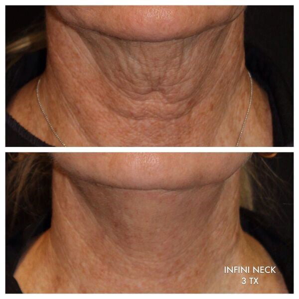 INFINI Skin Tightening Laser Results