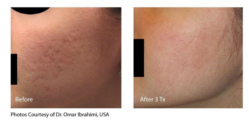 INFINI Acne Scar Treatment Results