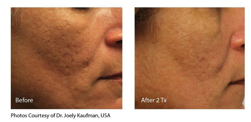 INFINI Acne Scar Before & After Photo