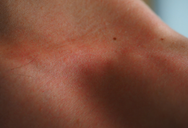Mary Lee Amerian - Dry_Sensitive Skin