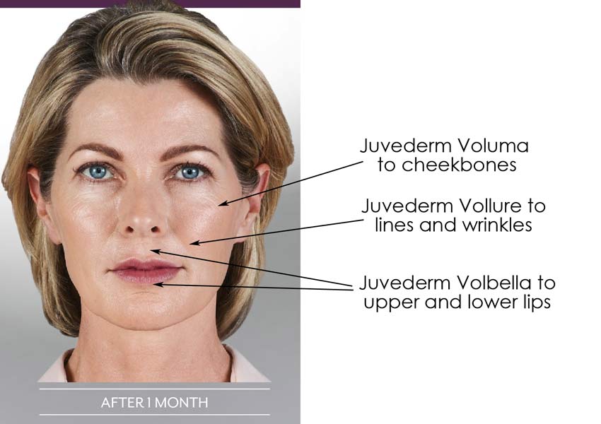 Your Guide to Juvederm Types: Voluma, Volbella & Vollure