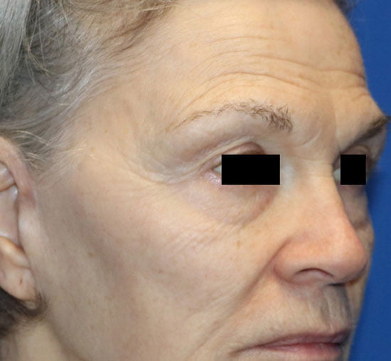 Patient 3 After | TempSure Before and After Photo