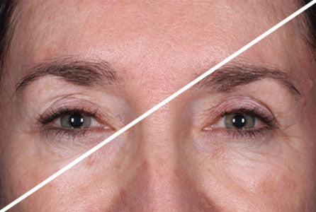 Daxxify | The Santa Monica Laser & Skin Care Center