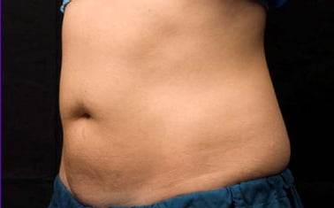 CoolSculpting Belly Fat Reduction After