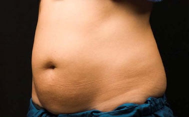CoolSculpting Belly Fat Reduction Before